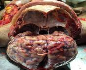 Post mortem examination of the brain from korua 3xxx post mortem sex